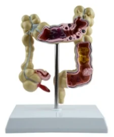 

Pathological Large Intestine Model Medical Science Human Colon Anatomy Simulator Teaching Aids for Education