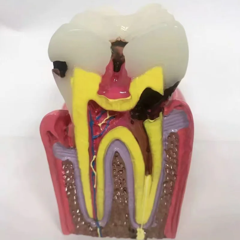 6 Times Dental Caries Teeth Model Periodontitis Case Analysis Teeth Model Dentist Anatomy Teaching Studying Demonstration Model