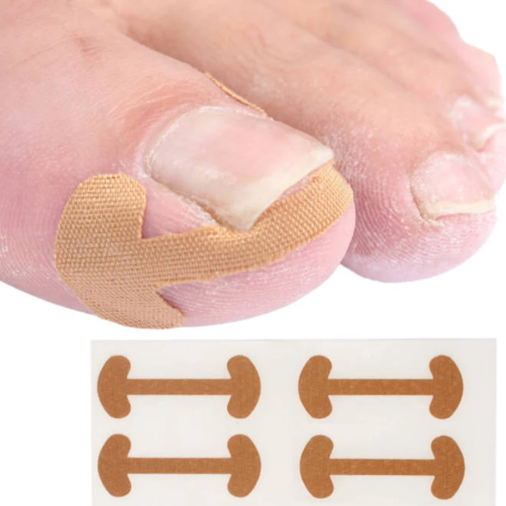 20-100pcs Professional Ingrown Toenail Foot Corrector Sticker Breathable Adhesive Toenail Patch Foot Correction Care Accessories