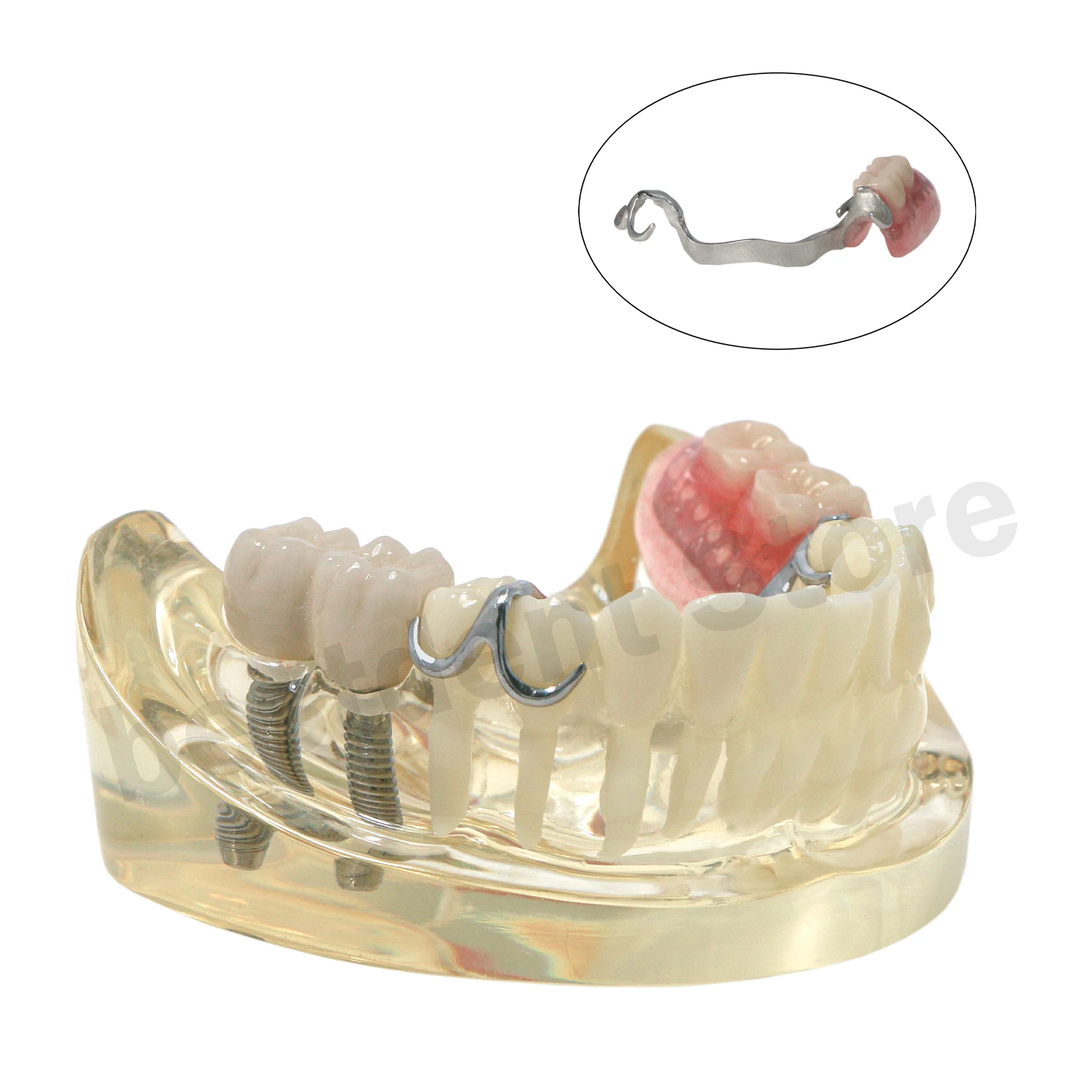 

Dental Teeth Model Implant and Restpration Typodont with Partial Denture M6022