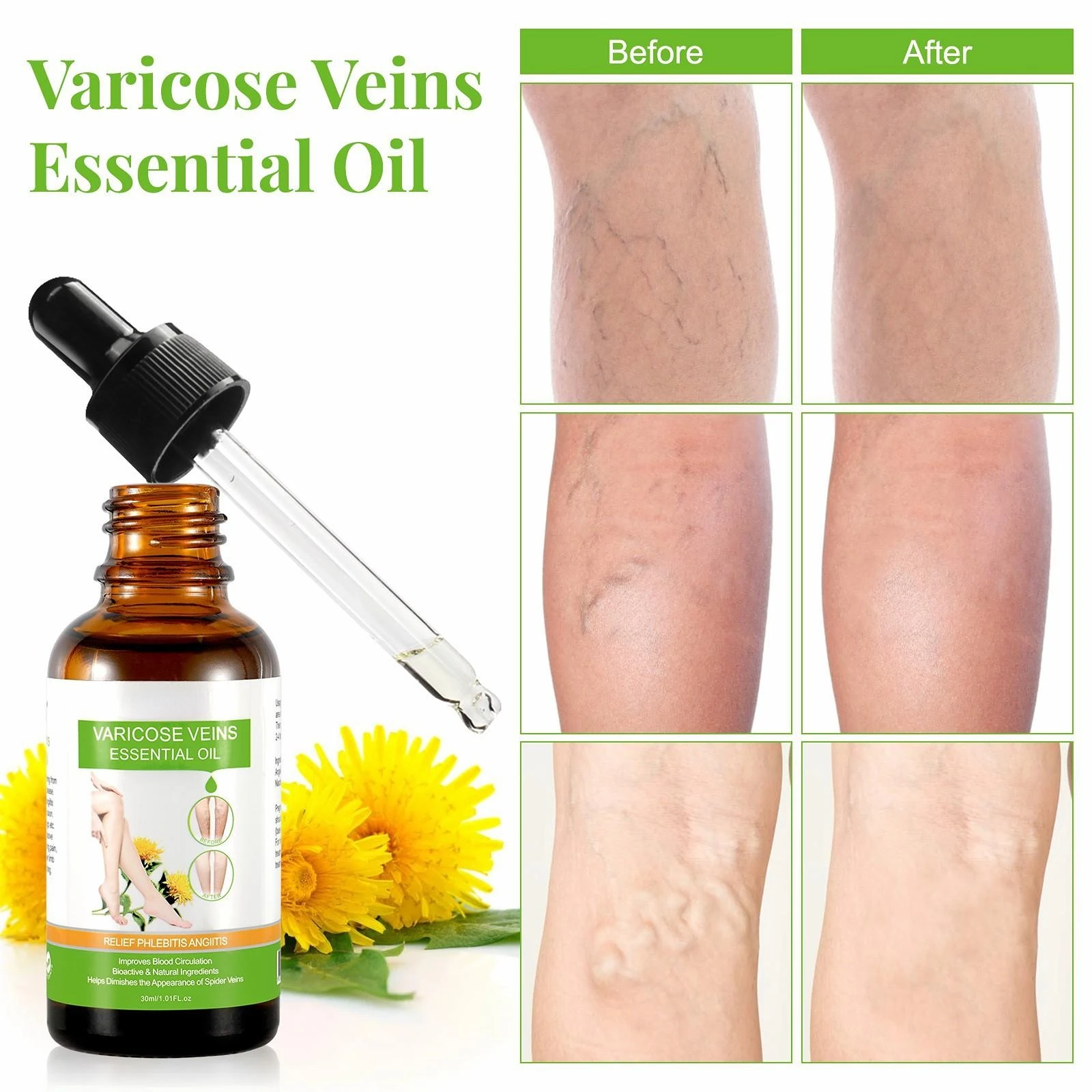 Repair Venous Injury Varicose Essence Essential Oils Legs Care Essential Oil Leg Moisturizing Vein Massage Vein Bulge