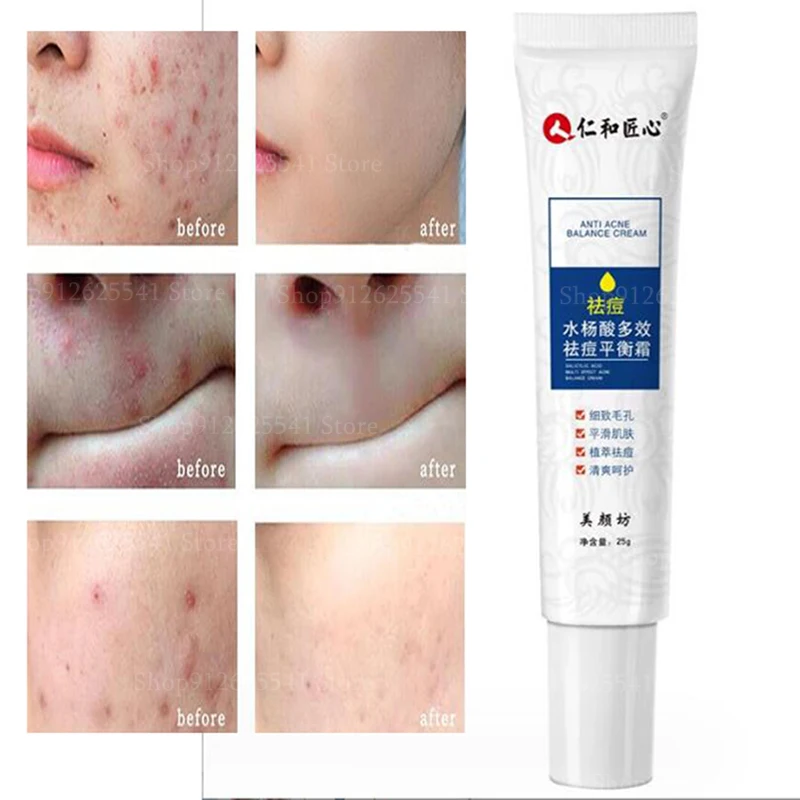 

Anti Acne Face Cream Salicylic Acid Acne Removing Cream Waterproof Balancing Cream for Acne Scars and Pits Reduce Blemishes