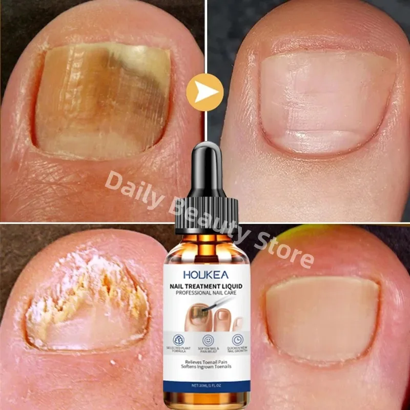เชื้อราเล็บ Treatment Serum Foot Repair Liquid Toe เล็บ Fungal Removal GEL Anti Infection Paronychia Onychomycosis ครีม 30ml