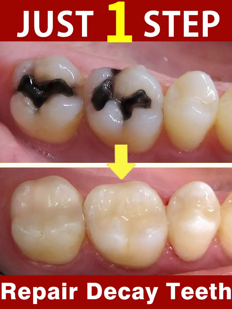 2024 Novo R & D para reparar rapidamente a cárie dentária e proteger os dentes