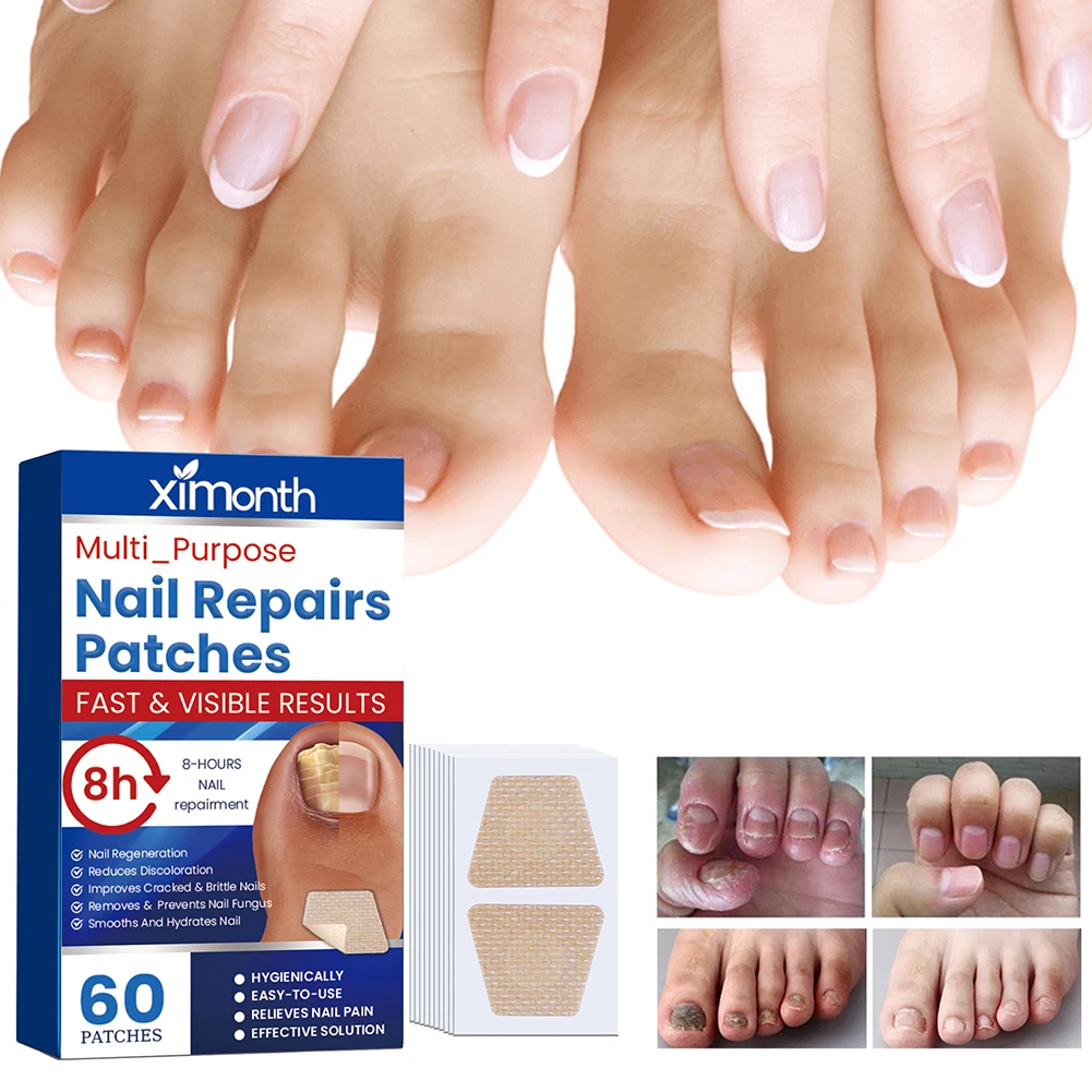 60Pcs Toenail Fungus Patch Sticky Nail Repair Patches Nail Ingrown Correction Stickers for Discolored Or Damaged Nails