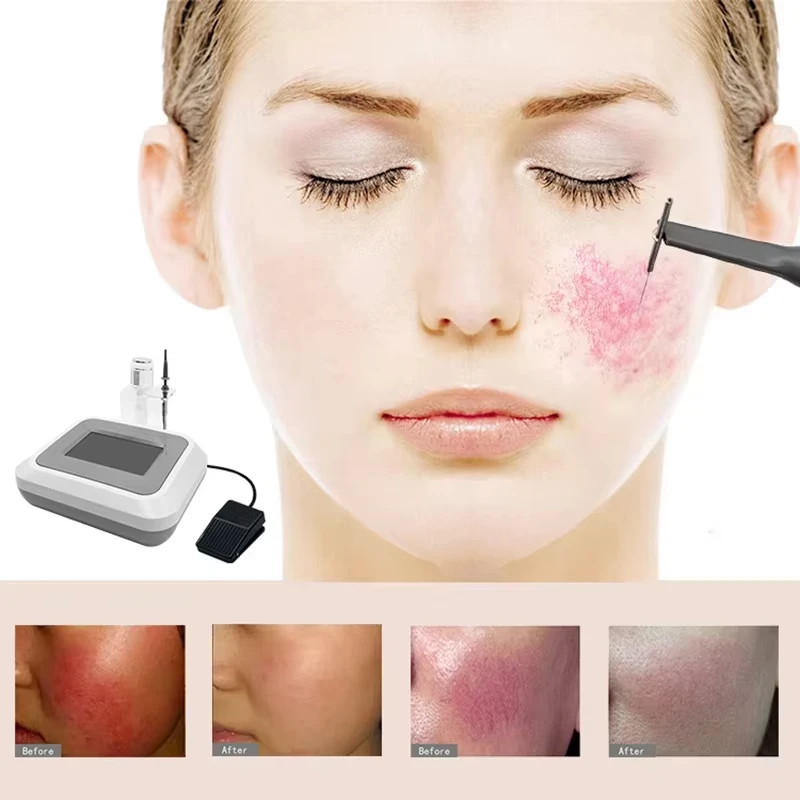 El más nuevo equipo de belleza para eliminar arañas vasculares, aguja para eliminar manchas de vasos sanguíneos rojos de alta frecuencia, máquina antienrojecimiento