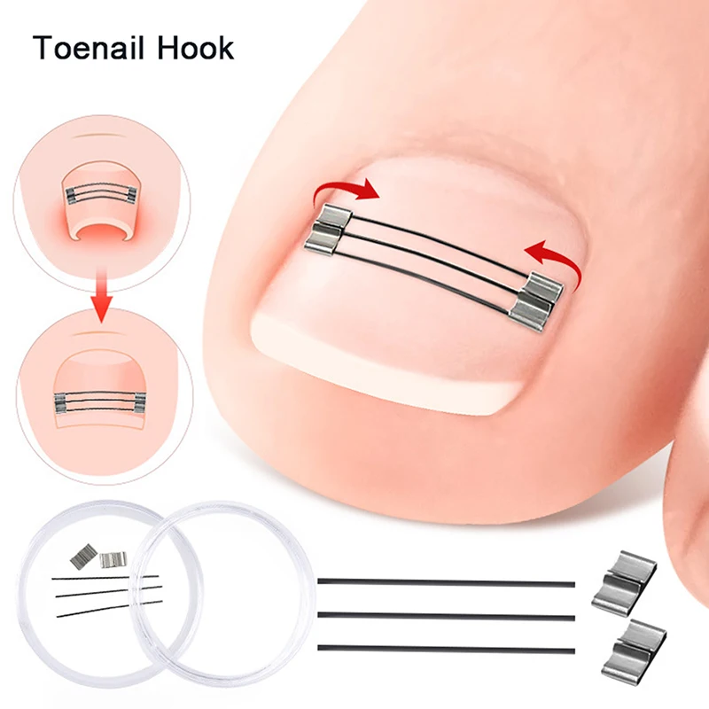 Corrector de uñas encarnadas, herramientas de sujeción, recuperación de pedicura, tratamiento de uñas encarnadas profesional, alisado de uñas encarnadas