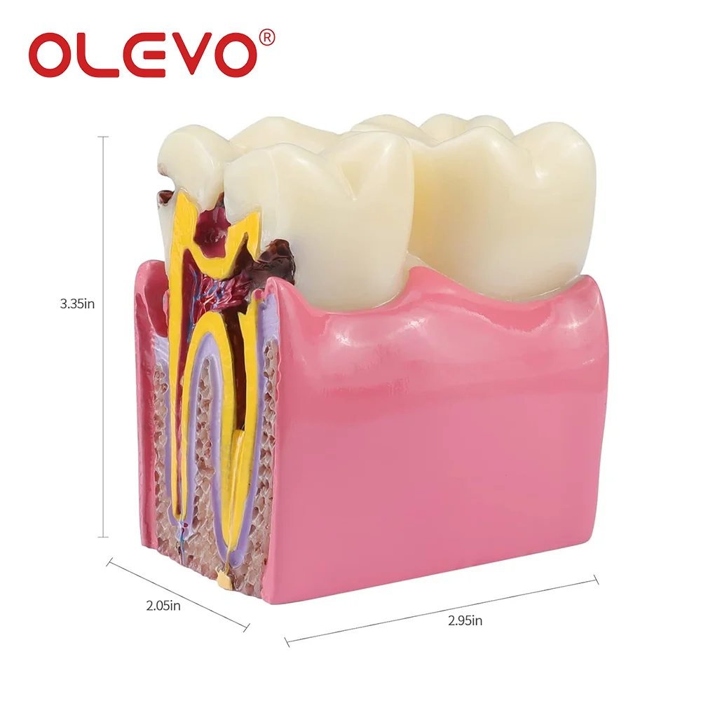 OLEVO, nauczanie stomatologiczne, Model zębów 6-krotne porównanie próchnicy, demonstracja studenta studiującego Model protezy laboratoryjnej