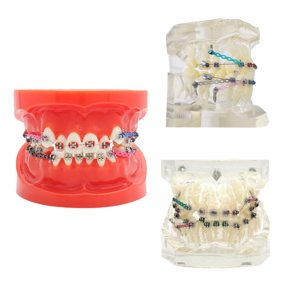 

Dental Teeth Model Orthodontic Model Teeth With Metal Brackets Malocclusion Correction For Orthodontic Teaching Demo