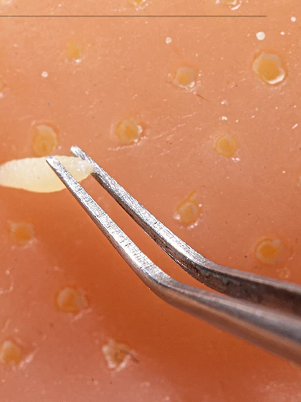 لعبة تخفيف التوتر على شكل جهاز تنظيف الرؤوس السوداء، لعبة محاكاة صغيرة لعصر البثور، لعبة مزحة إبداعية لجميع الأعمار