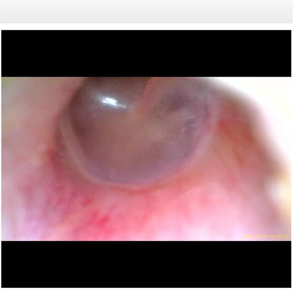 

Sale Otoscope Ear Endoscope 3.9mm 4.5 IPS 1080p HD Ear Scope Wax Removal Cleaner Tools with 2500mAh Rechargeable Battery