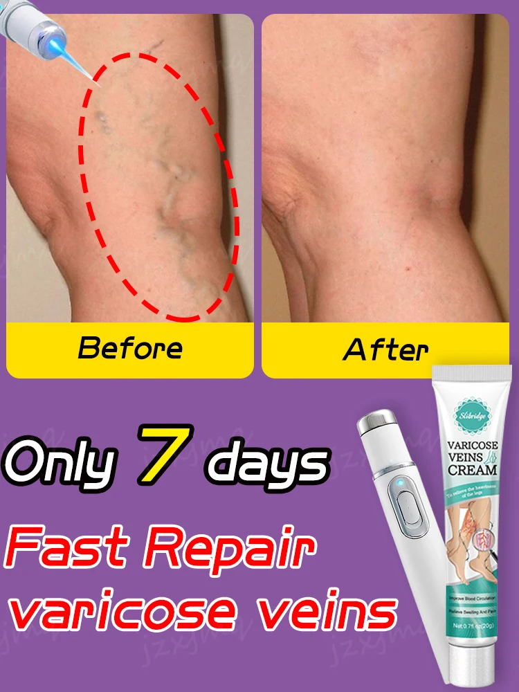 

Лазерная ручка от варикозного расширения вен, облегчение флебита, улучшение кровообращения