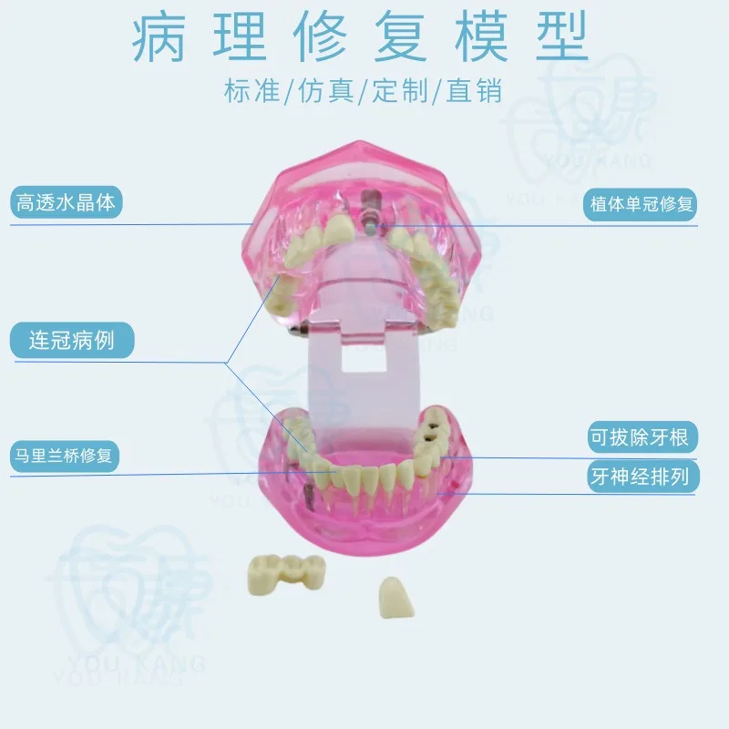 Restoration model, dental pathology, doctor-patient communication, teaching prosthosis, comprehensive removable dental mold