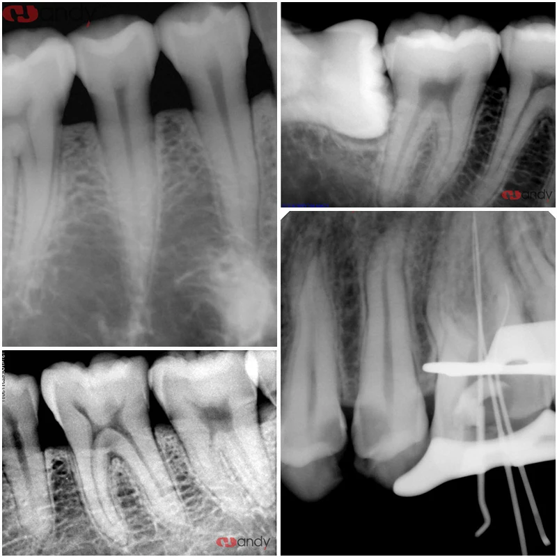 Dental X-Ray Sensor Radiovisiograph RVG Digital Intraoral System HD Image for Dentistry With Multilingual Handy HDR500C/600C