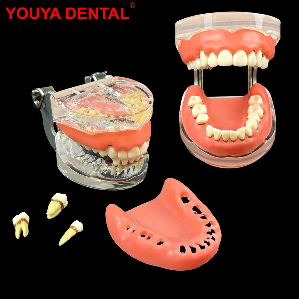 

Мягкие десны, стоматологические заболевания пародонта, Typodont, съемный зуб, обучающая модель зубов для стоматолога, пациента, образовательный дисплей