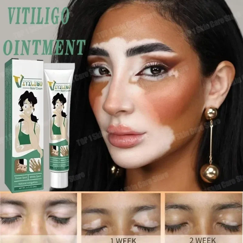 

Vitiligo Removal Cream White Spot Care Cream Skincare cream vitiligo skin Sweat spot Reduce white spots Skin care New