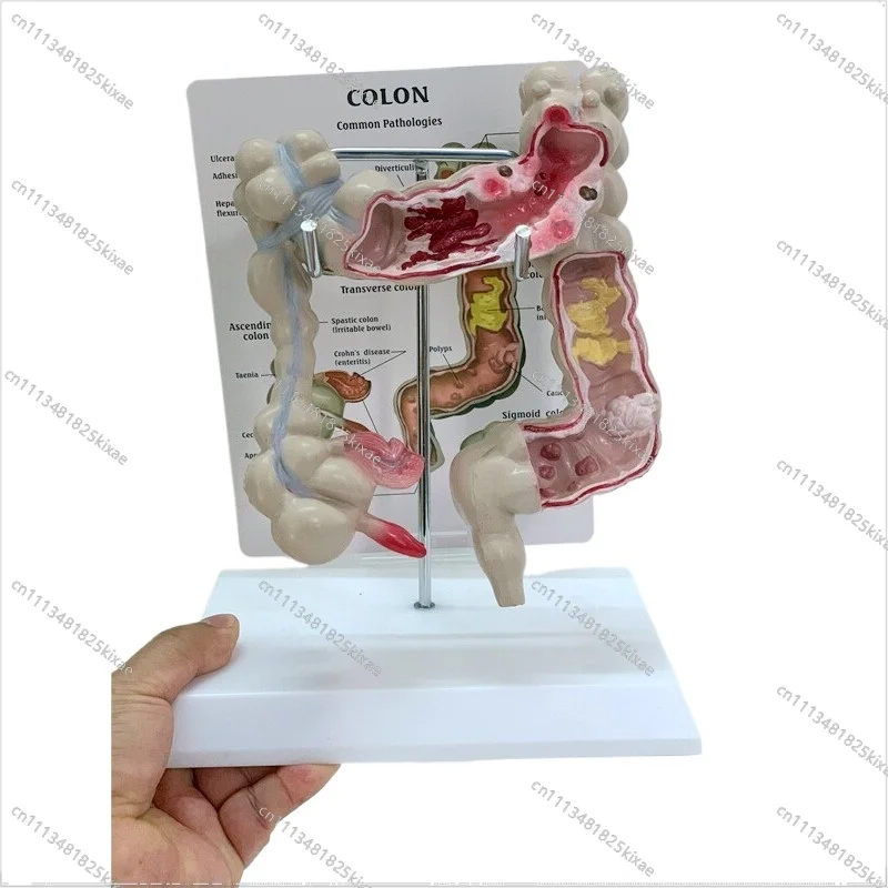 For Colon Pathology Model, Colon Model, Colon Lesion Model, Intestinal Disease, Human