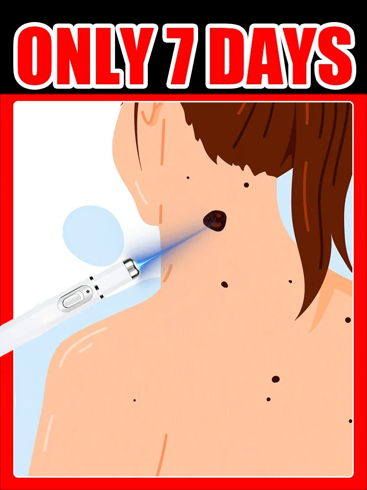 

wart care tools，Hot selling blue light pen to solve body warts