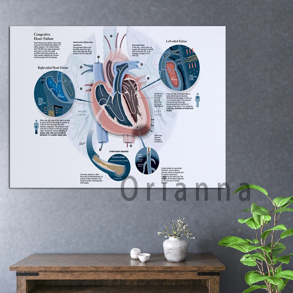 Hd Print Wall Art Congestive Heart Failure Horizontal Canvas Poster Heart Failure Awareness Home Decorpainting Cardiologist Gift