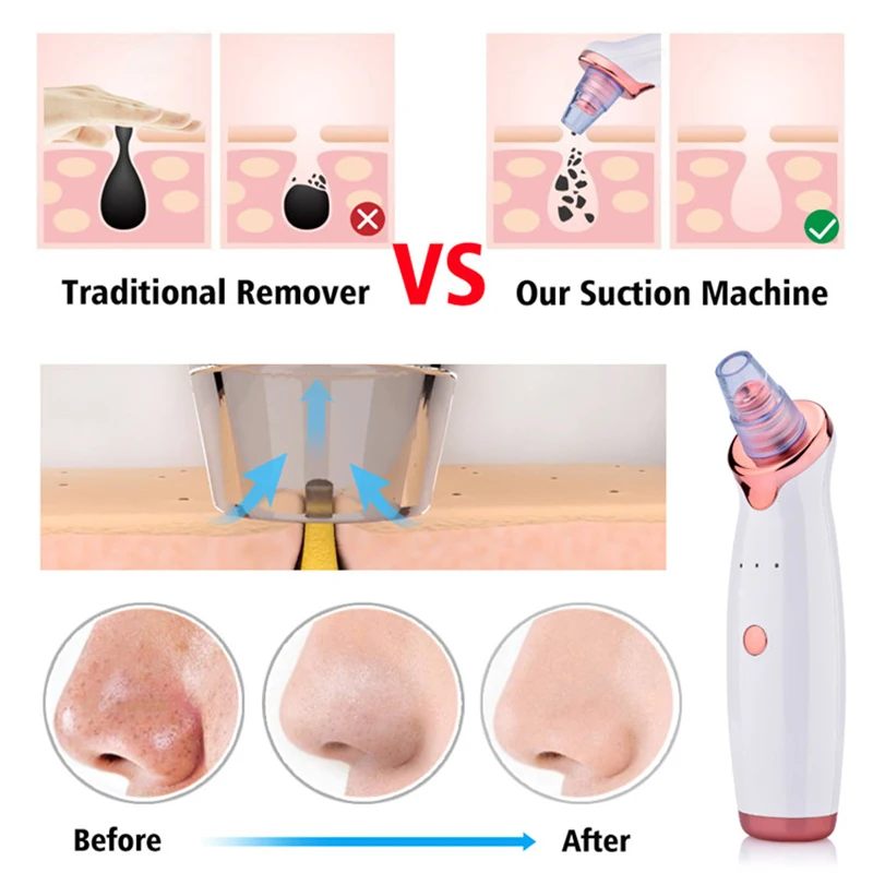 Removedor elétrico de cravo facial, limpador de poros a vácuo, limpador de acne, remoção de manchas pretas, rosto, nariz, ferramentas de limpeza profunda