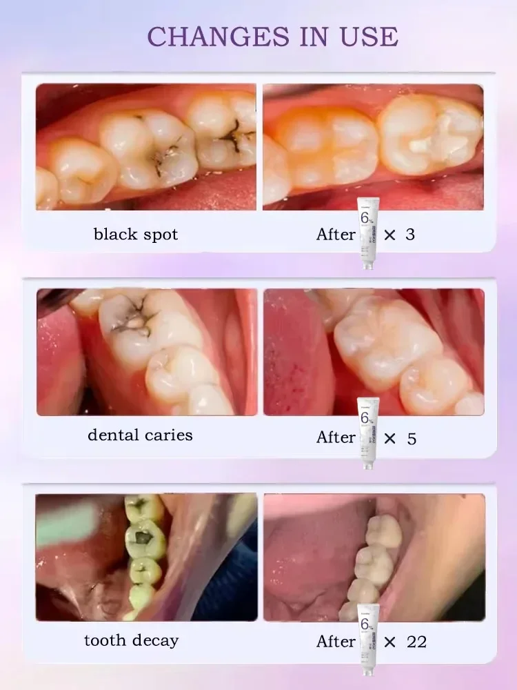 Anti Caries Repairing Cavities Tooth Decay Repair