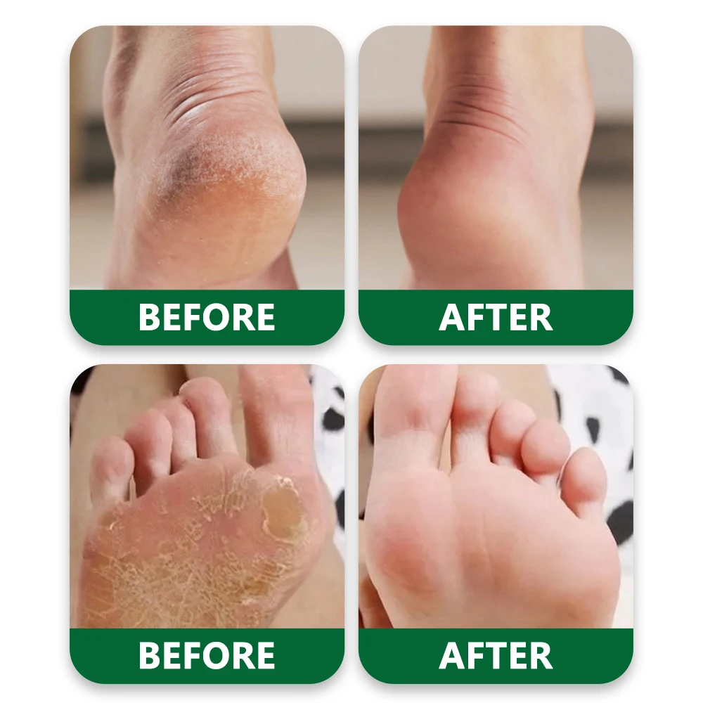 Tea Tree Oil Foot Cream, Warming Cream - Calluses, Dry Cracked Feet, Hands, Heels, Elbow -Softens & Moisturizes Skin, Foot Balm