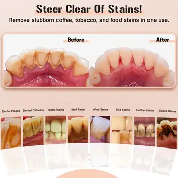 超音波潔牙機,用於去除牙垢、牙漬、牙結石,電動聲波潔牙機,可去除牙菌斑和牙石。 8 最佳銷售 超音波牙齒清潔器 - №4
