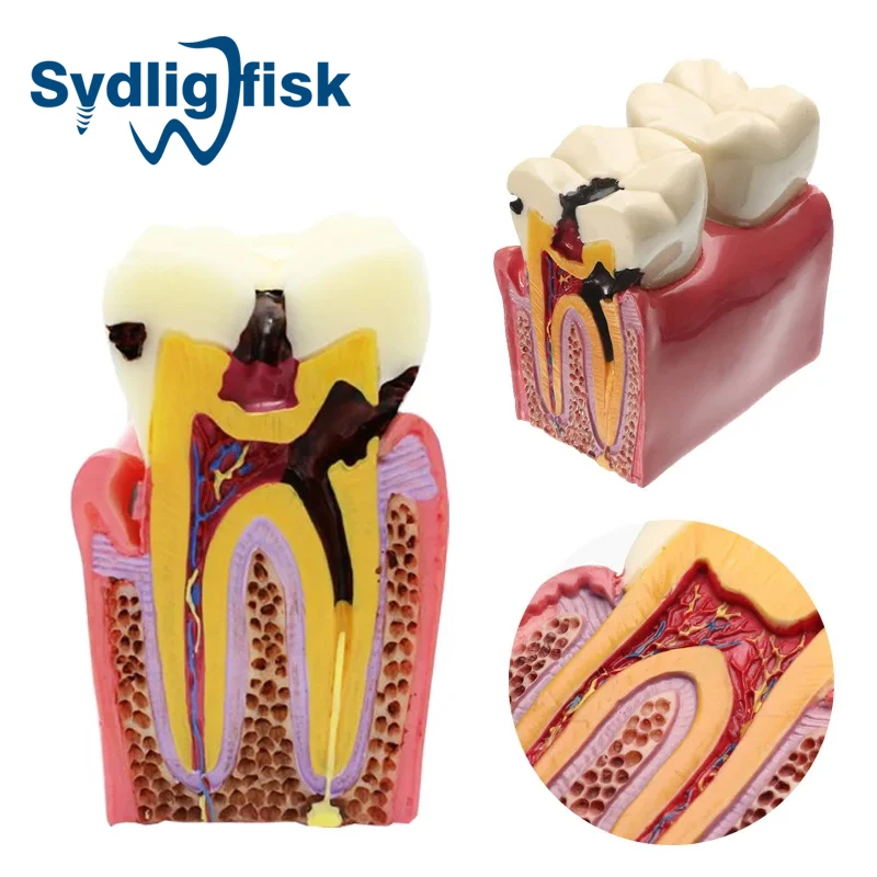 

Dental Teeth Model 6 Times Caries Comparative Study Denture Tooth Models Dentist Studying and Researching Dentistry Product