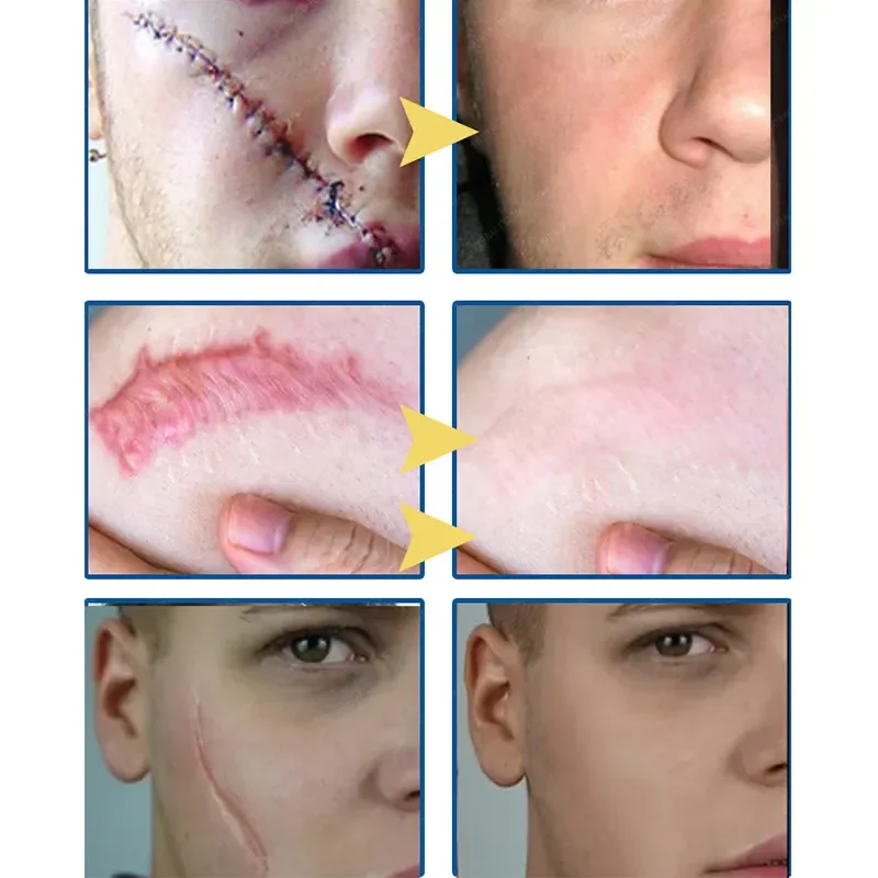 Effective Scar Removal Cream Treatment Stretch Marks Acne Scars Repair Gel Burn Surgical Scars Whitening Moisturizing Skin Care