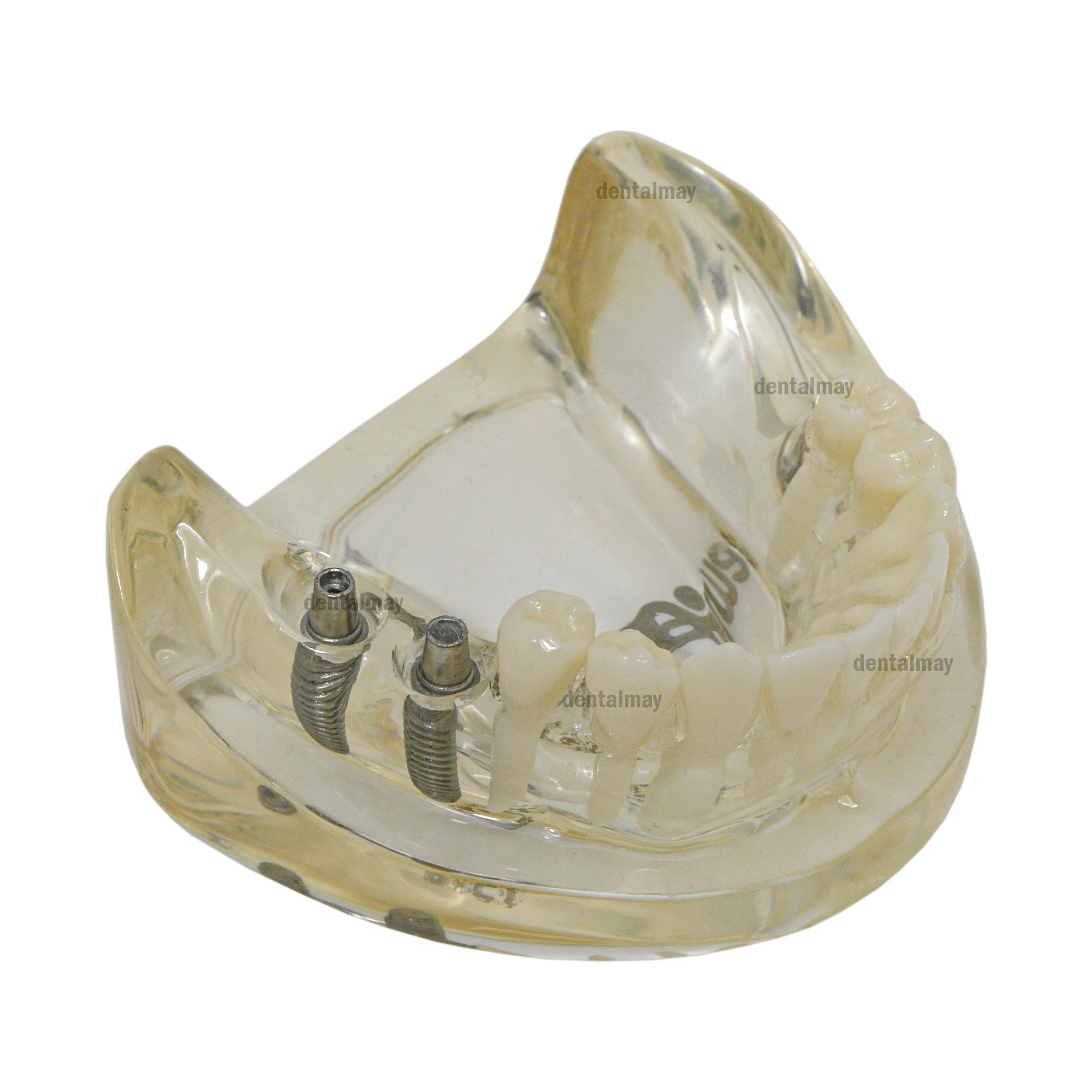 Dental Typodont Removable Partial Dentures Model RPD Demo Retainer With 2 Implants M6022-1