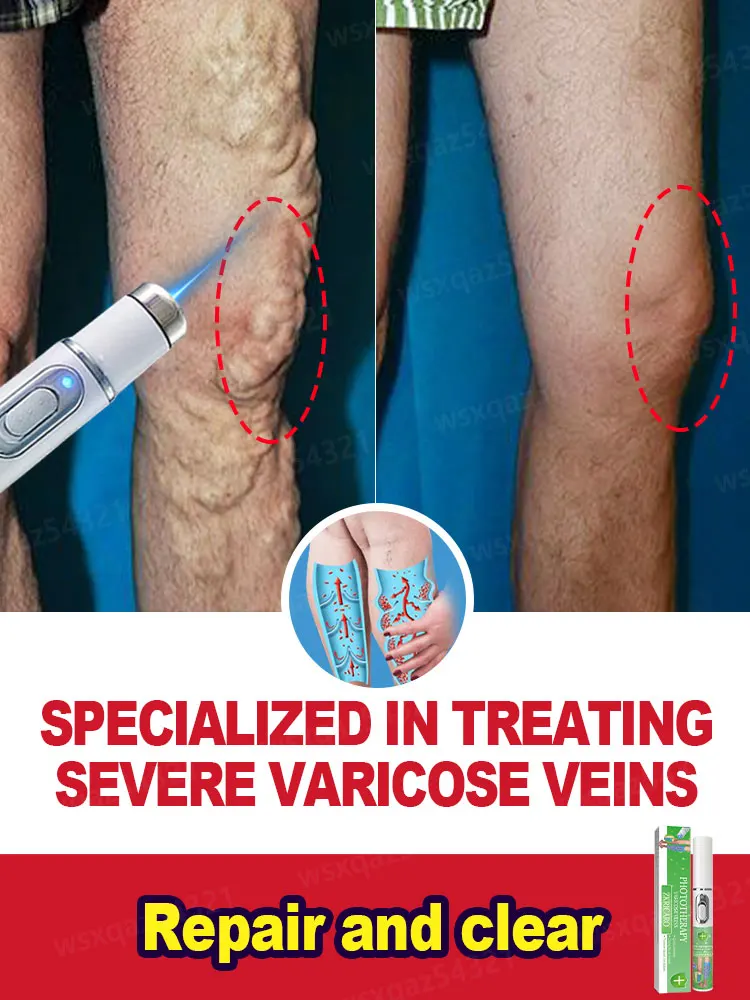 

Effective solution for varicose veins