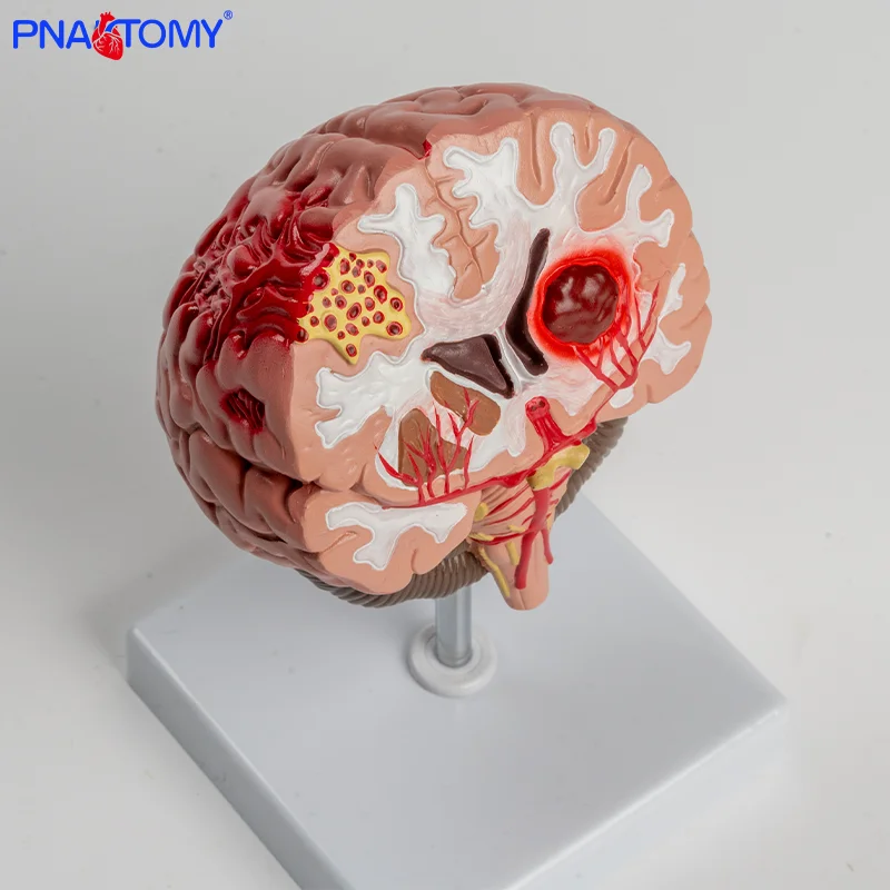 

Brain Anatomical Model Cerebral Hemorrhage Arteriovenous Malformation of The Brain Brain Pathology