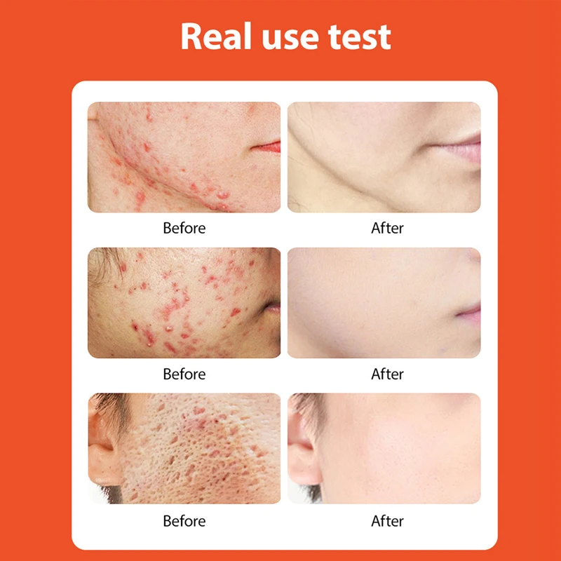 Remoção de acne de ervas creme facial anti-acne gel tratamento acne cicatriz poros encolhendo eliminar poros grandes espinhas clareamento cuidados