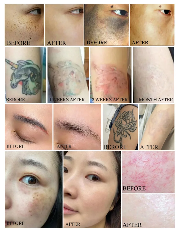 rejuvenation Picosecond  Therapy Pigment Tattoo Mole Freckle Removal Dark Spot Remover Machine