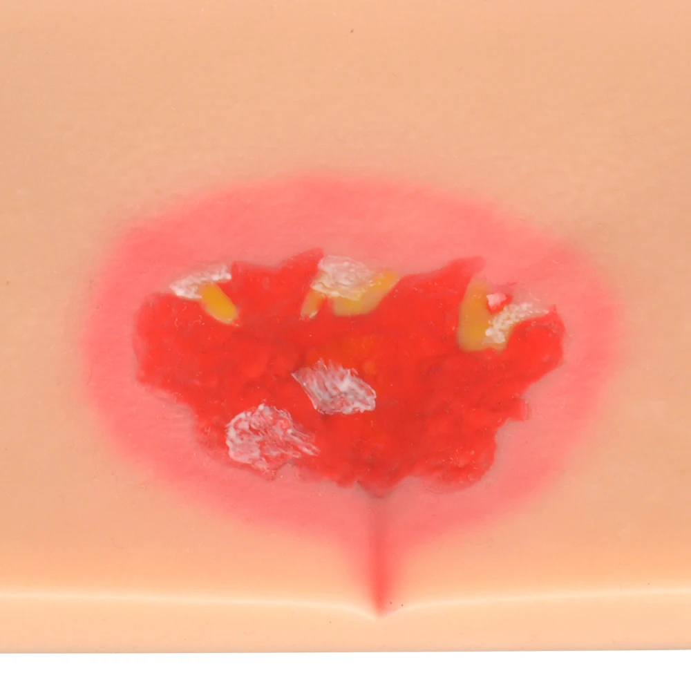 زخم ضغط السيليكون (المرحلة 1-4) نموذج تمريض مظاهرة، محاكي السيليكون، نموذج للتدريس