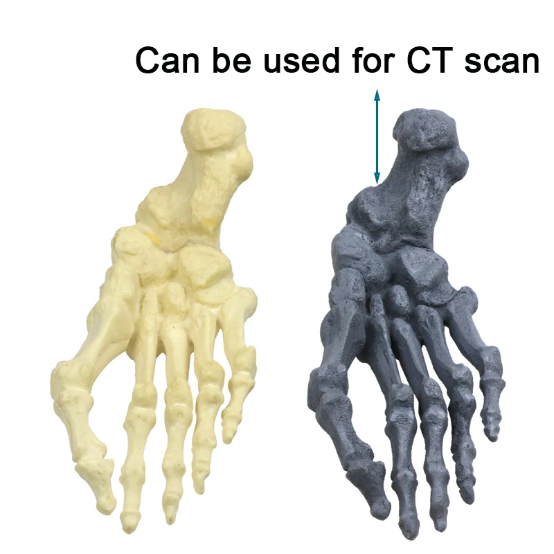 Medical Thumb Ectropion Model Hallux Valgus Correction Model Cortical Bone Foam/cancellous Cartilage Model