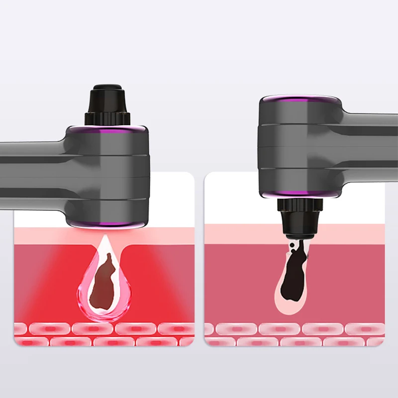 Nuovo dispositivo elettrico per la rimozione dei punti neri: dispositivo di bellezza del viso per la rimozione dell'acne e dei comedoni, strumento per la cura della pelle a casa