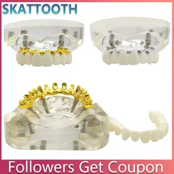 Dental Implant Model with Overdenture Restoration Teeth Upper Jaw Tooth Removable Implant Model for Dentisit Teaching Research