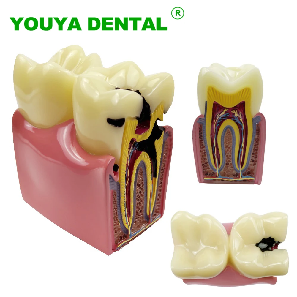 Dental Teeth Model Anatomy Caries Oral Model Tooth Comparsion Teaching Models Dentist Studying And Researching Dentistry Product