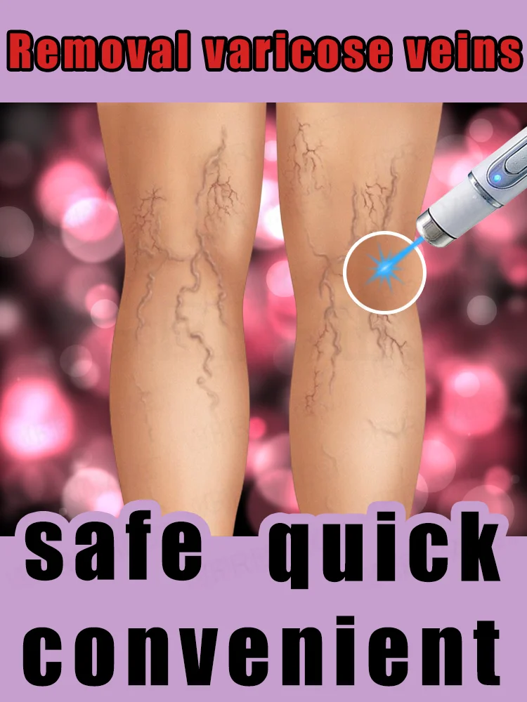 

Lᴀsᴇʀ ʀᴇᴍᴏᴠᴀʟ | Pʀᴏғᴇssɪᴏɴᴀʟ ᴛᴇᴀᴍ | Cᴏɴᴠᴇɴɪᴇɴᴛ ᴀɴᴅ ғᴀsᴛ ʀᴇᴍᴏᴠᴀʟ ᴏғ ᴠᴀʀɪᴄᴏsᴇ ᴠᴇɪɴs, ʜᴀɴᴅʜᴇʟᴅ ʟᴀsᴇʀ ɪʀʀᴀᴅɪᴀᴛɪᴏɴ, ʜᴏᴍᴇ sᴛʏʟᴇ ᴘᴏʀᴛᴀʙ