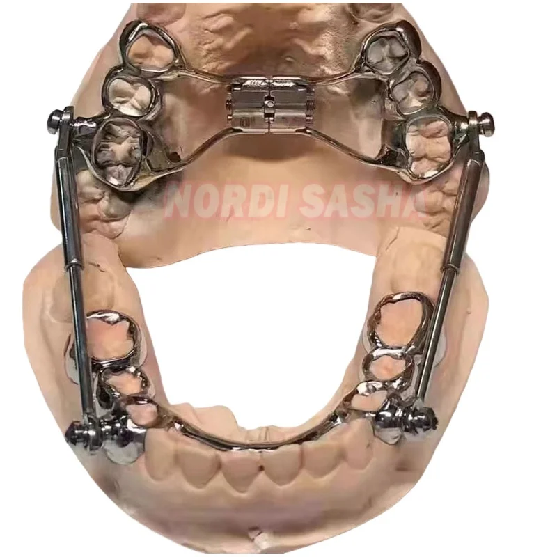 1 conjunto de aparelho dental herbst conjunto denturum parafuso soquete telescópico ortodôntico classe ii correção