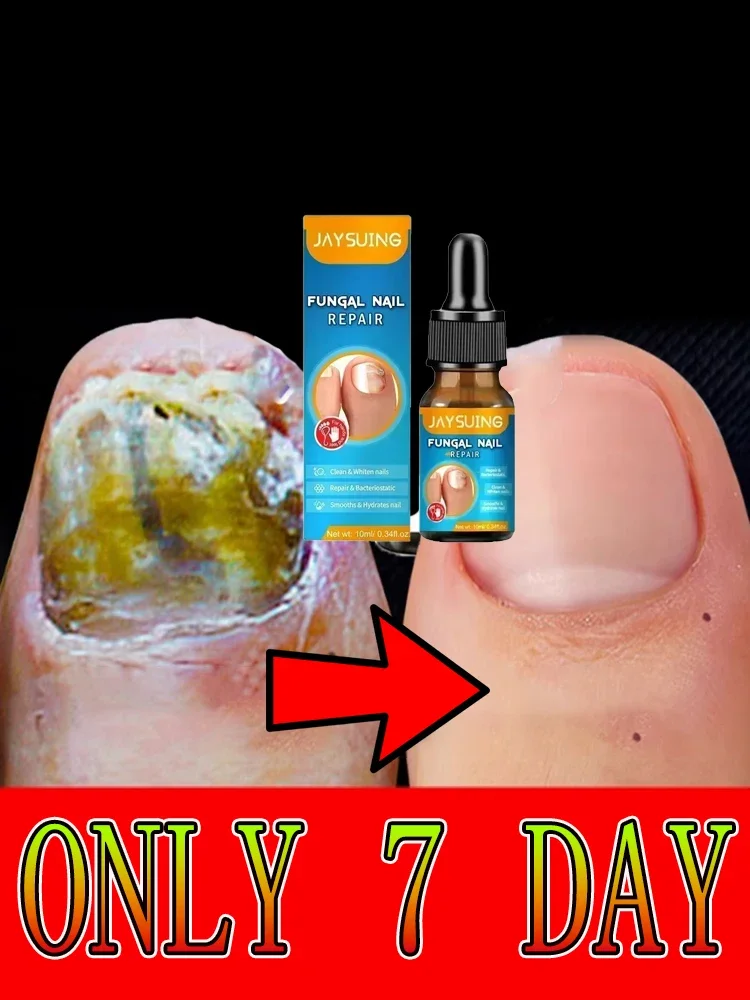 Toe Nail Fungus Removal Gel with Anti-Infection Cream, Fast-Acting Formula,