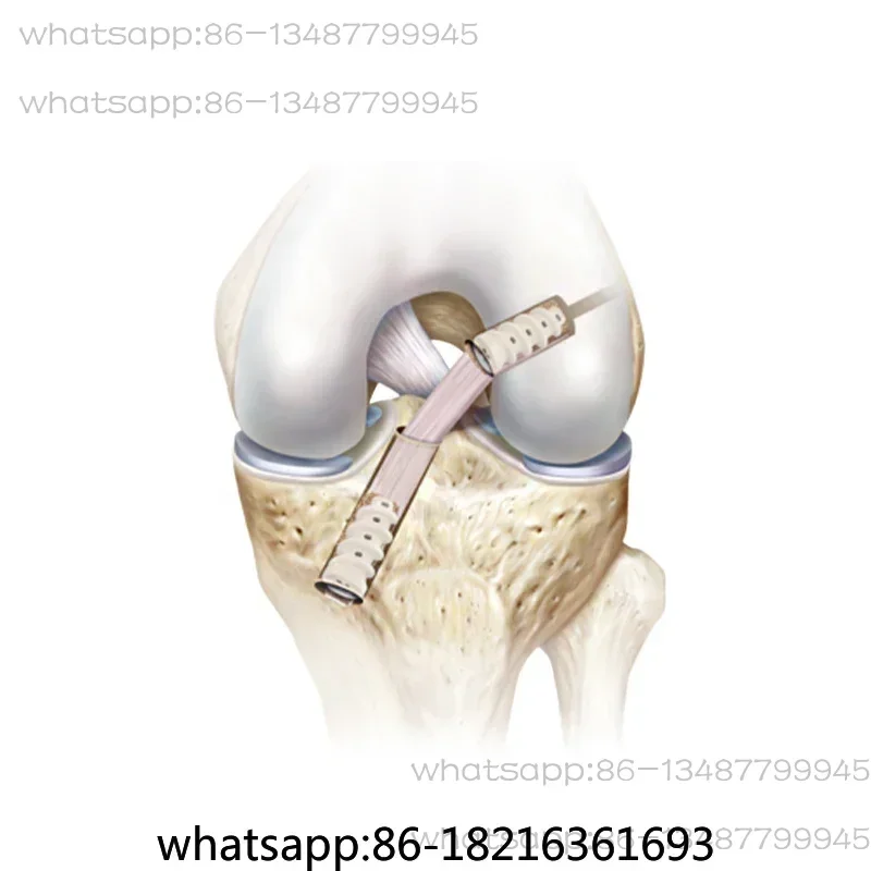 Acl Repair Screws Tibia End Ligament Reconstruction PEEK Interference Screws