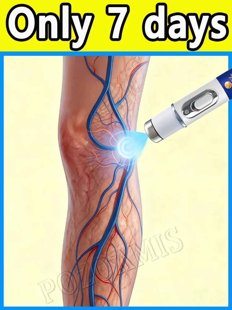 

О варикозном расширении вен для улучшения кровообращения.