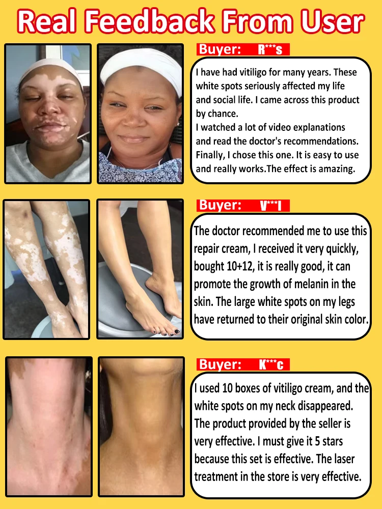 vitiligo magic tool