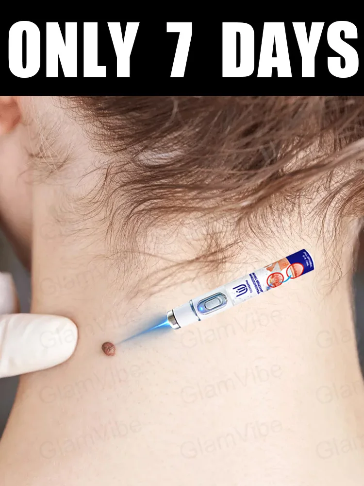 

blue light pen solve warts, hot sale wart care tools