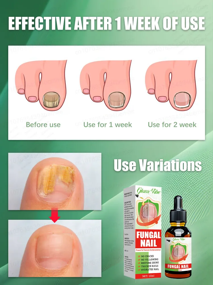 ผลิตภัณฑ์กำจัด Onychomycosis กำจัดเชื้อรานิ้วไม่เดือดร้อนจากเล็บที่น่าเกลียดอีกต่อไป