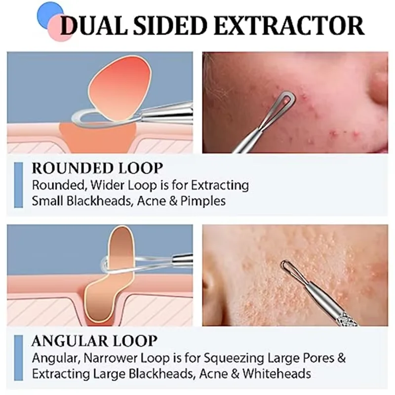 ชุดแหนบสิวที่แม่นยําเป็นพิเศษ 4/8 ชิ้น - เครื่องมือกําจัดสิวและสิวหัวดําแบบมืออาชีพ - สําหรับการดูแลผิวที่มีประสิทธิภาพและการทําให้บริสุทธิ์ของผิว