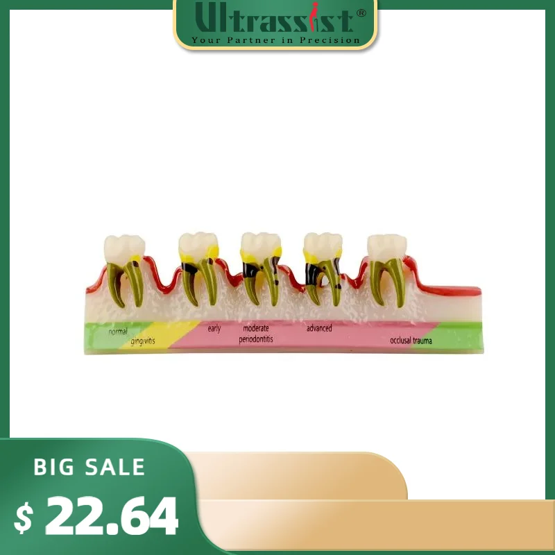 

Ultrassist Periodontal Disease Model, Dental Teeth Model For Dental Tooth Anatomy Study, Doctor-patient And Oral Care