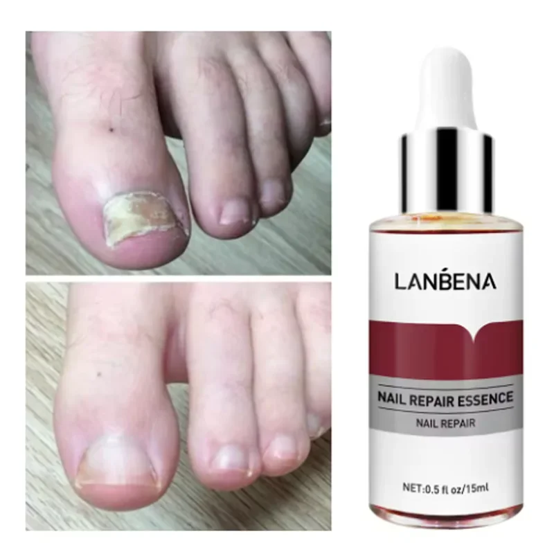 2024 LANBENA Fungus Care Remove Onychomycosis Toes Nourish Brighten Hands Feet Product Repair Suitable Women Nail Pepair Essence